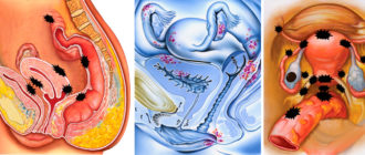 Можно ли заниматься сексом при лечении эндометрита
