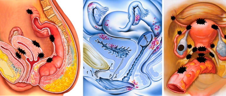 Можно ли заниматься сексом при лечении эндометрита