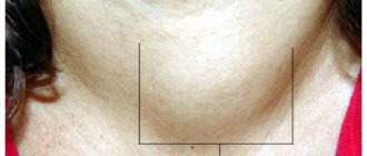 Узловое образование 12 мм щитовидной железы опасно ли это