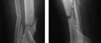 Многооскольчатый перелом голени