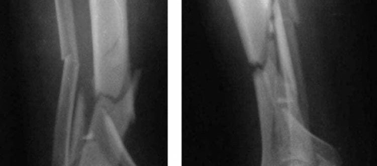 Оскольчатый перелом. Оскольчктый перелом рентгенперелом. Оскольчатый перелом голени рентген. Осколочный перелом рентген. Оскольчатый перелом рентген.