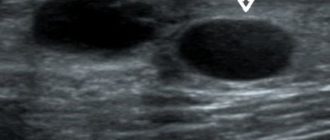 Узи признаки кист молочных желез