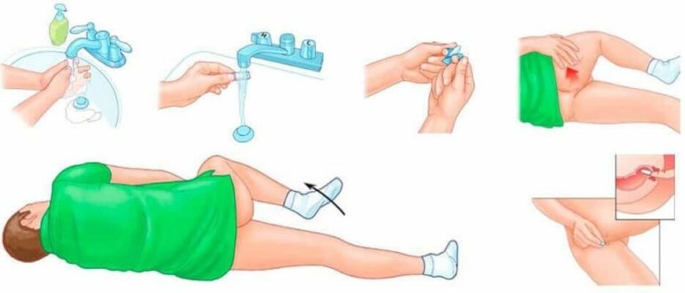 Можно ли одновременно применять свечи ректально и вагинально