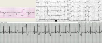 Достали экстрасистолии