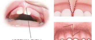 Восстановление после пластики уздечки