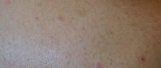 Чешется и зудит на лопатке в одном месте