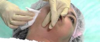 Нано эпиляция