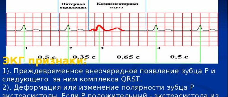 Экстрасистолия что делать