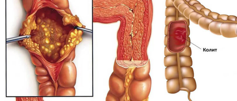 Воспаление кишечника у ребёнка
