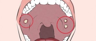 Внутри опухло горло