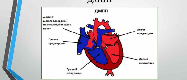 Дмпп 5 мм, нужна ли операция?