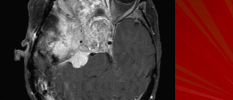 Менингиома основания черепа