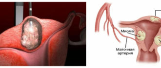 Миома матки. Есть ли необходимость в опреции