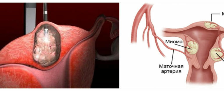 Миома матки. Есть ли необходимость в опреции
