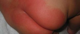 Диатез на попе и ножках уже около 2 недель