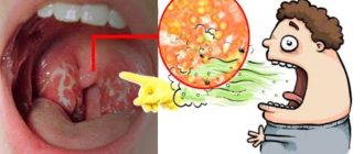 Выделение бело-желтых комочков изо рта