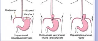 Экстрасистолия при Грыже пищевода