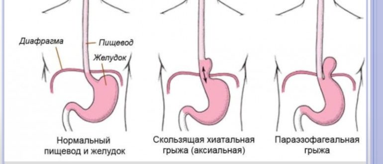 Экстрасистолия при Грыже пищевода