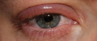 Чешется верхнее веко внутри