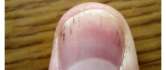 Чёрные полоски под ногтями