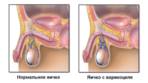 Что делать, когда член и яйца залезает внутрь тела?