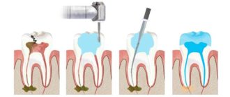 Мышьяк и удаление нерва