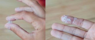 Молочница появляется каждый месяц