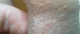 Временами зуд, белый налёт и прыщики на головке полового члена