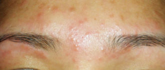 Внутренний прыщ под бровью