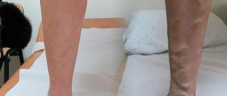 Можно ли принимать визанну при варикозе