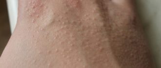 Мелкие прыщики на руках переходящие в черные точки