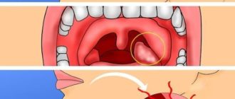 Воспаление миндалины справа. Боли при открывании рта
