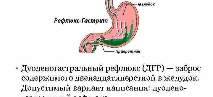 Дуоденогастральный рефлюкс, лимфоидный гастрит