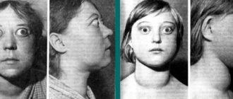 Диффузный зоб 1 степени с субклиническим гипотериозом