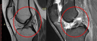 МР-признаки частичного повреждения передней крестообразной связки. Реактивный синовиит. Дегенеративн