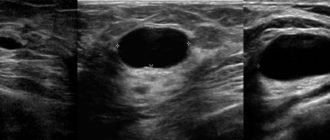 УЗИ картина м/железы. Кисты левой молочной железы