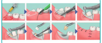 Депульпирование или удаление 8 зуба мудрости