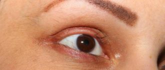 Выпадение ресниц