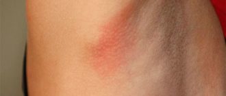 Чешется под мышкой