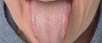 Дисбактериоз налет на языке