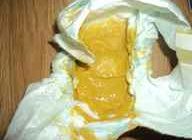 Диарея 4 день, по 5-6 раз за день,