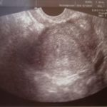 Выделения и тянущие боли 11 недель беременности