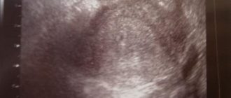 УЗИ и задержка месячных на пять дней