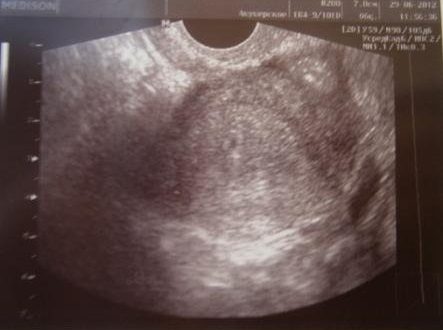 УЗИ и задержка месячных на пять дней