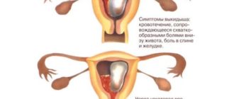 Может ли болеть низ живота при выкидыше