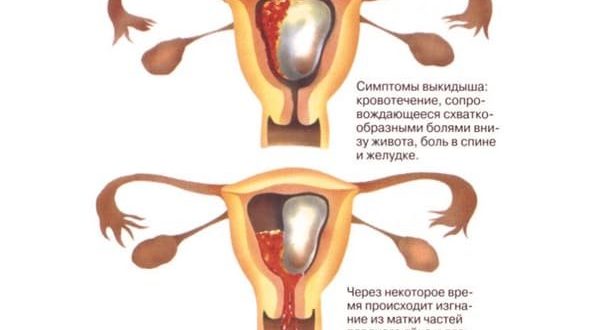 Может ли болеть низ живота при выкидыше