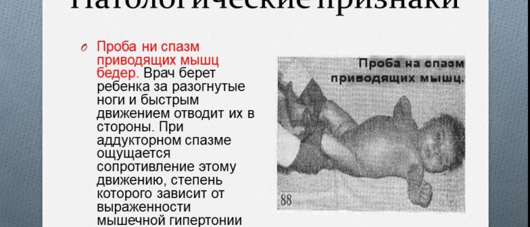 Дисплазия или аддукторный спазм?