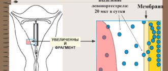 Мирена и выделения