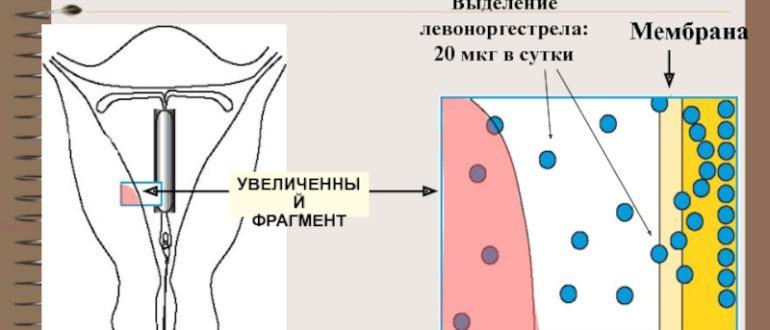 Мирена и выделения