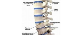 Дистрофические изменения в пояснично-крестцовом отделе